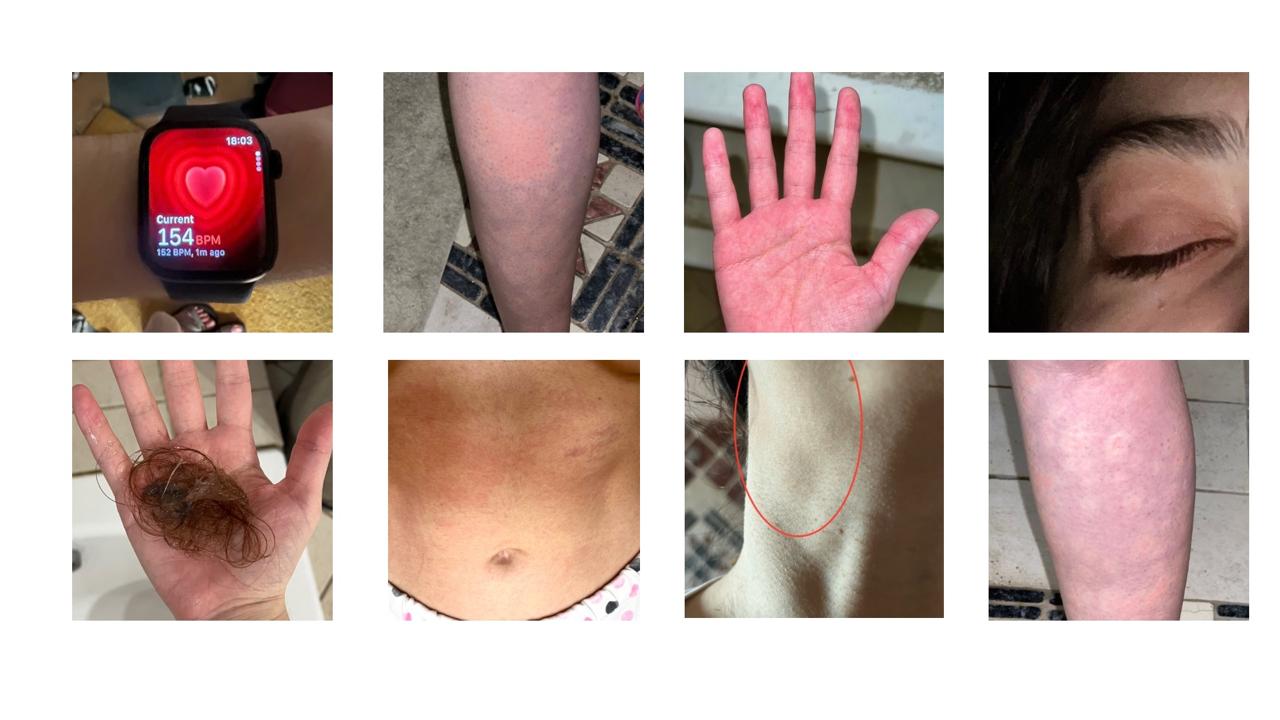 Eight squares showing a range of Katiana's symptoms. Top left displays her smartwatch showing her heart rate at 154 bpm while standing. Next over shows a rash on her foreleg. Across from that shows the palm of her hand going bright red. Top image on the right is Katiana's closed eye looking swollen. In the bottom left, Katiana is holding a clump of her hair that's fallen out. Next over is her stomach bloating. Then, the picture alongside this shows her swollen lymph nodes in her neck. Final image is more blotchy skin with hives on her arm ME/CFS severe ME